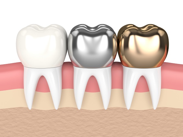 Dental Crown Procedure? 