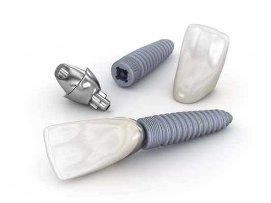 Avoiding Infection With Dental Implants