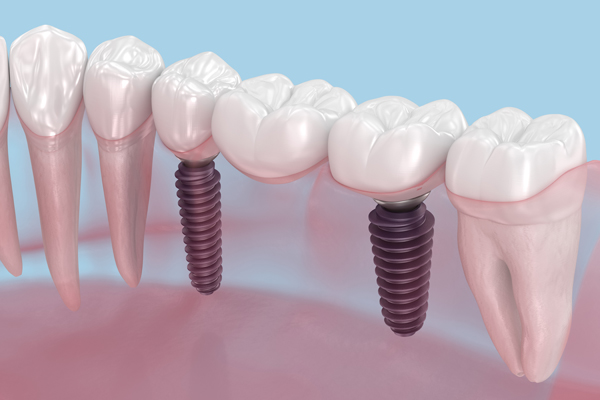 Dental Implants Step By Step: Procedure And Recovery