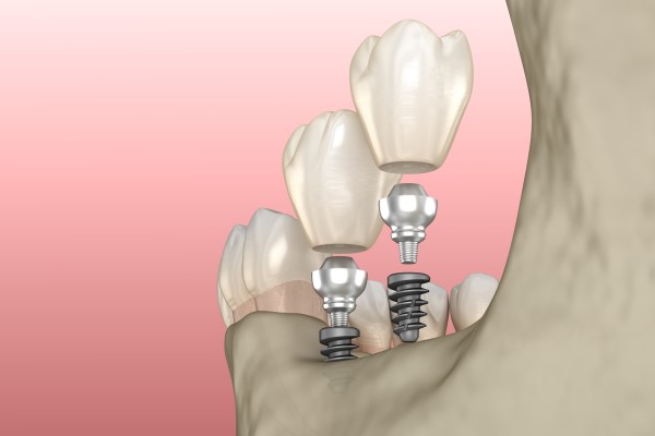 Dental Implants Port Charlotte, FL