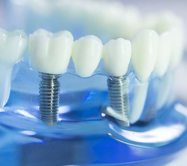 Port Charlotte Dental Implants