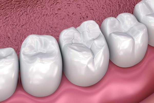 Composite Filling &#    ; A Dental Restoration Procedure Option
