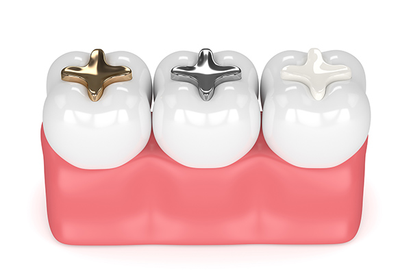 General Dentistry Questions: What Is A Dental Filling Used For?