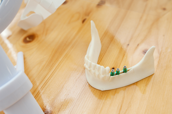 What To Discuss With Your Implant Dentist About Your Treatment Plan