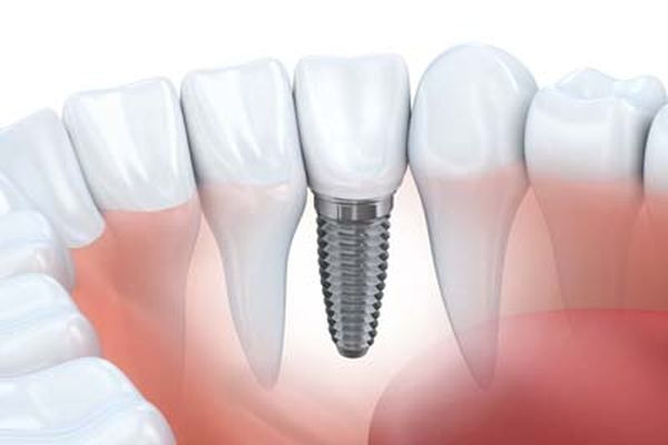 An Implant Dentist Gives Seniors Options For Replacing Teeth