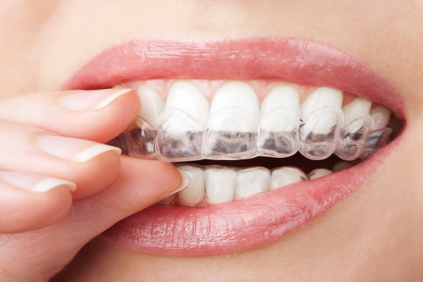What Is An Ideal Age For Invisalign®?