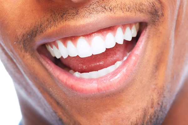 Reasons To Get A Smile Makeover For A Missing Tooth